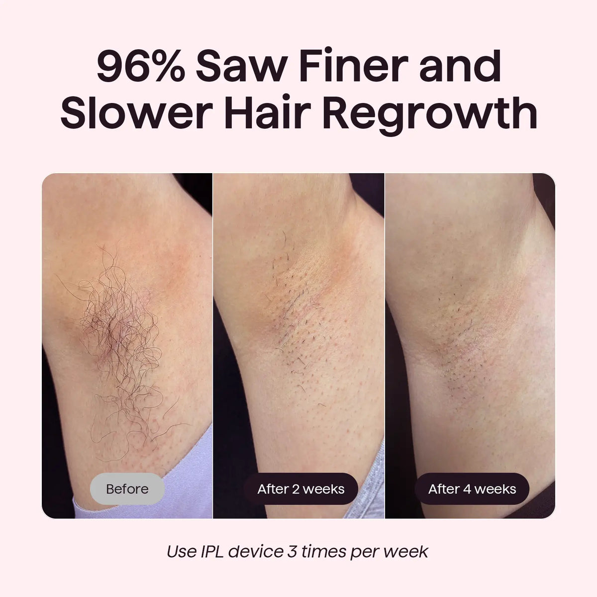 JJJSHOP Bare It IPL Hair Removal with Ice Cooling, 3 Modes & 24J Dual-Pulse for Salon-Level Results on Face, Body & Bikini, Painless & Precise